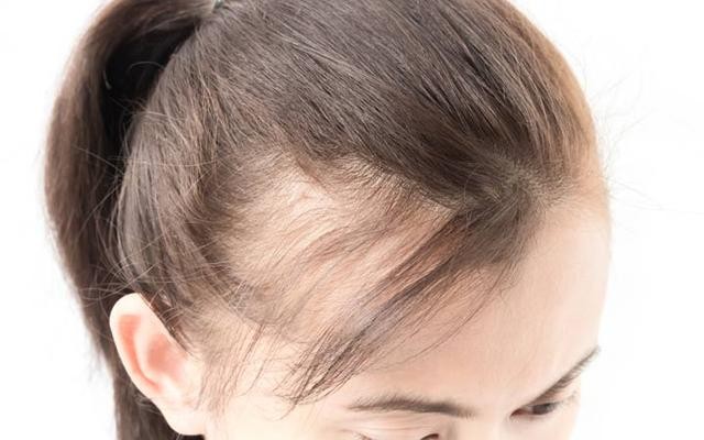 hair fall treatment