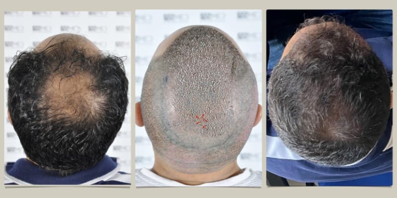 hair transplant