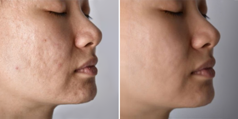 SQT Bio Microneedling